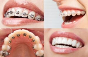 Các loại niềng răng phổ biến