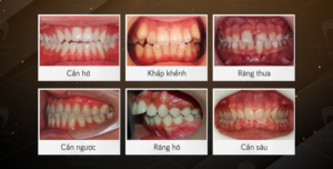 Chi phí cho một ca niềng răng bao nhiêu tiền