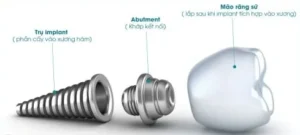 Cấu tạo của răng implant gồm những gì?