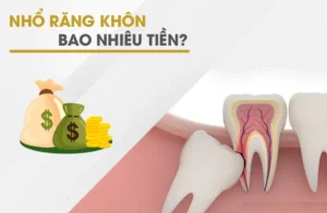Chi phí nhổ răng khôn