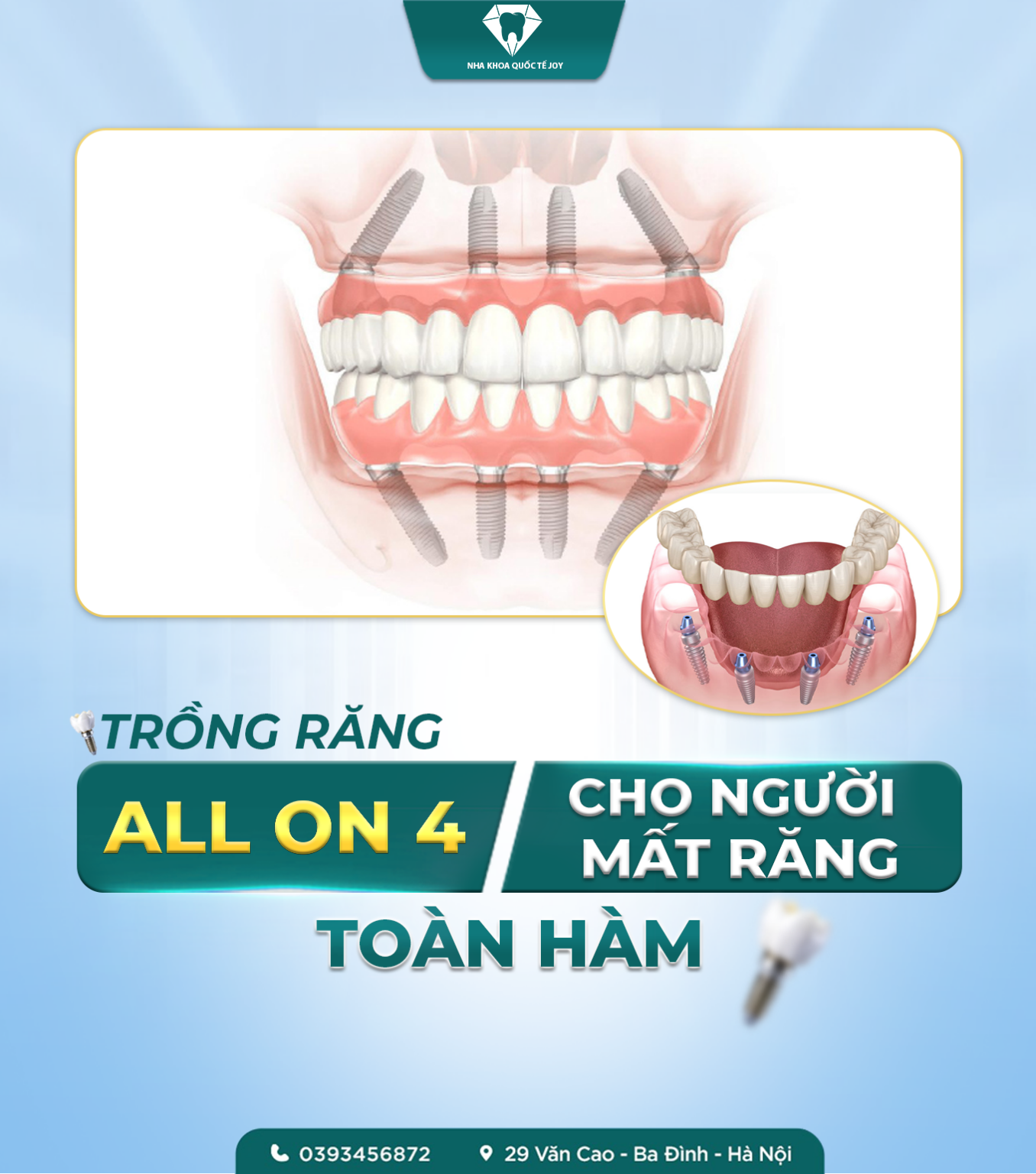 Chi phí trồng răng all on 4