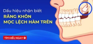 Dấu hiệu nhận biết răng khôn mọc lệch