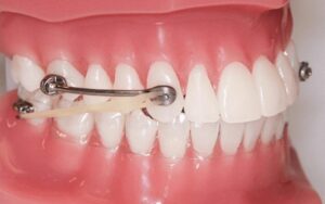 Dụng cụ niềng răng tại nhà bằng mắc cài từ dây thép