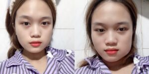 Hiện tượng bị sưng lợi, sưng má