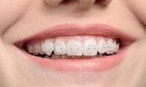 Loại niềng răng mắc cài sứ thường