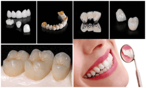Loại răng sứ mà bạn chọn