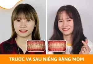 Lợi ích sau niềng răng móm