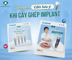 Những điều cần lưu ý khi cấy ghép implant