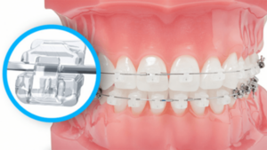 Nhược kiểm khi niềng răng mắc cài sứ