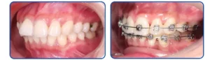 Niềng răng hô với mắc cài kim loại