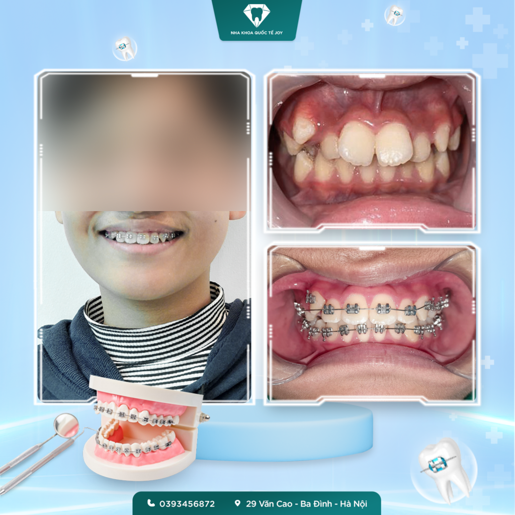 Niềng răng là gì?