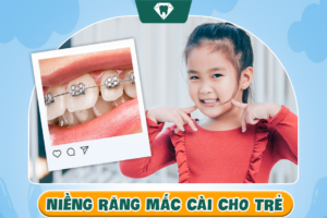 Niềng răng mắc cài cho trẻ em