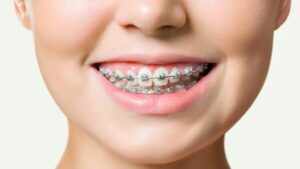 Niềng răng mắc cài kim loại