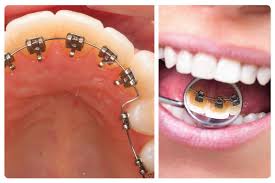 Niềng răng mắc cài mặt lưỡi