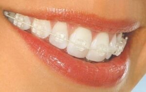 Niềng răng mắc cài sứ