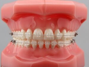 Niềng răng mắc cài sứ là gì