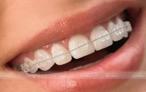 Niềng răng móm mắc cài sứ pha lê