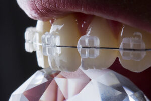 Niềng răng thưa mắc cài sứ