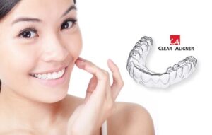 Niềng răng trong suốt Clear Aligner