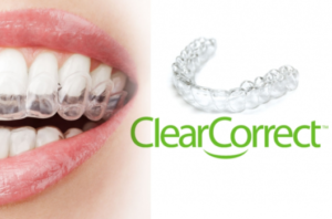 Niềng răng trong suốt Clear Correct