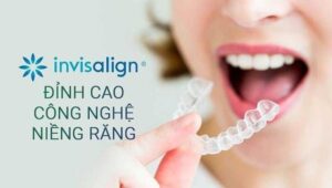 Niềng răng trong suốt Invisalign