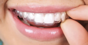 Niềng răng trong suốt Invisalign
