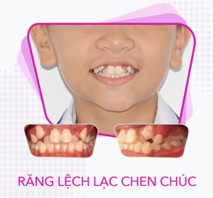 Phương pháp chỉnh nha tăng trưởng cho trẻ em