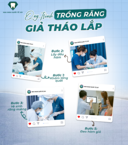 Quy trình trồng răng giả tháo lắp