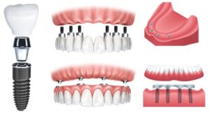 Răng giả tháo lắp trên implant