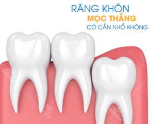 Răng khôn mọc thẳng