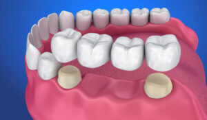 Số lượng răng sứ cần để làm cầu