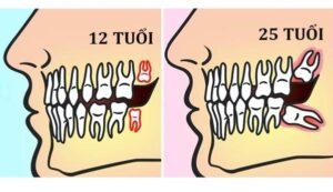 Tình trạng răng khôn mọc lệch