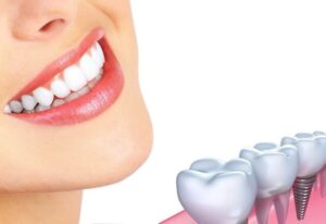Trồng răng sứ cố định