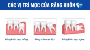 Vị trí mọc của răng khôn
