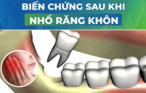 Biến chứng sau khi nhổ răng khôn