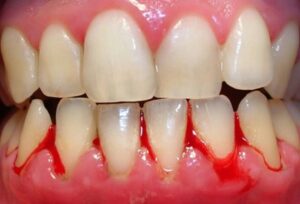 tình trạng bị viêm chân răng