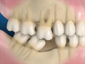 tình trạng răng bị xô lệch