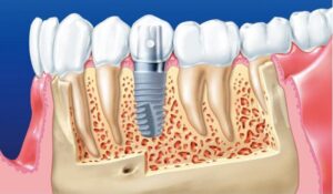 Trồng răng implant