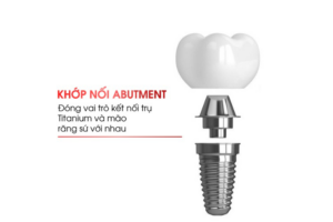Abutment được định nghĩa thế nào