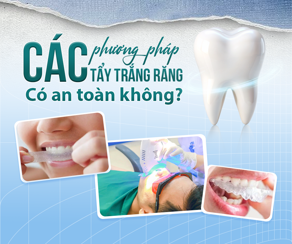 Các phương pháp tẩy trắng răng có an toàn không