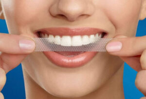 Cách tẩy trắng răng bằng các miếng dán trắng răng