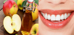 Cách tẩy trắng răng bằng giấm táo