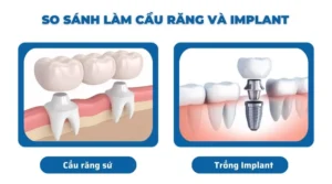 Cầu răng sứ và implant khác nhau thế nào