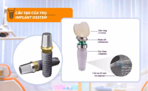 Cấu tạo cơ bản của trụ implant Hàn Quốc
