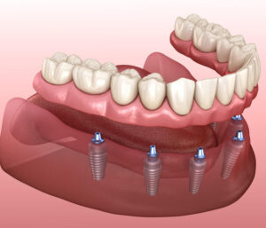 Hàm giả tháo lắp trên implant không có thanh bar