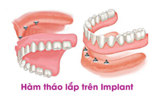 Hàm tháo lắp trên implant