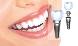 Hiệu quả thẩm mỹ vượt trội