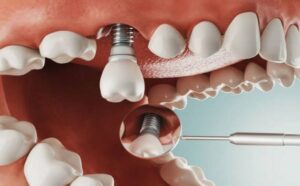 Implant là phương pháp nha khoa thế nào