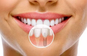 Mang đến cảm giác ăn nhai như răng thật