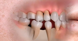 Ngăn ngừa tình trạng răng bị đổ